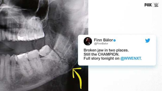 NXT Champion Finn Balor Suffered A Broken Jaw During His TAKEOVER Match With Kyle O'Reilly